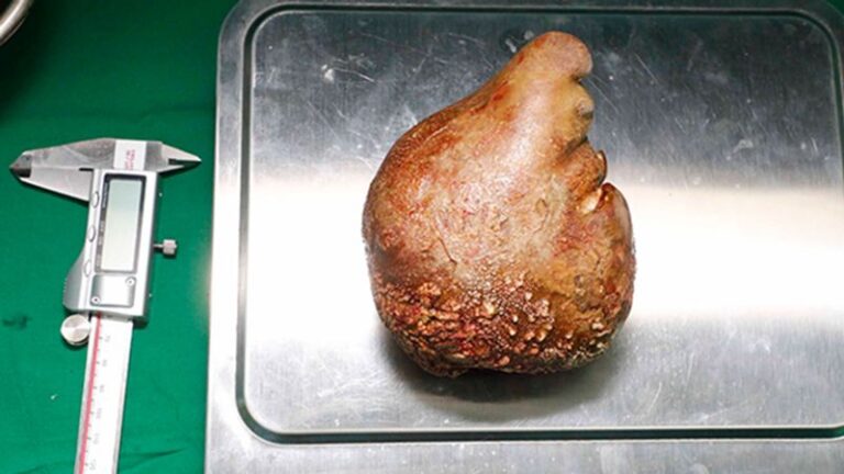 World’s largest kidney stone removed — and it’s the size of a grapefruit | CNN